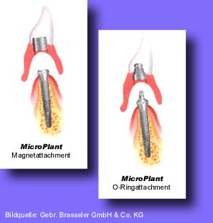 Implantate, Zahnarzt, Zahn, Kronen, Brcken, CBW, KCP, 3M, EDS, Zahnerhaltung, Zahnersatz, Parodontologie, Falkenberg, Fllungstherapie, Zahnsteinentfernung