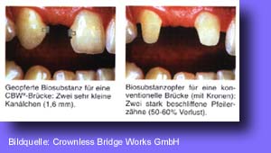Implantate, Zahnarzt, Zahn, Kronen, Brcken, CBW, KCP, 3M, EDS, Zahnerhaltung, Zahnersatz, Parodontologie, Falkenberg, Fllungstherapie, Zahnsteinentfernung